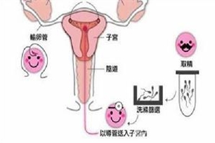 人工受孕