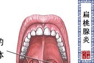 扁桃腺炎