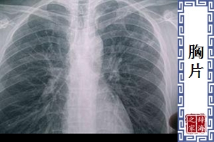 胸片