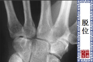 脱位