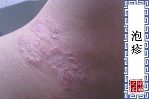 泡疹