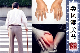 类风湿关节炎