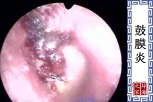 鼓膜炎