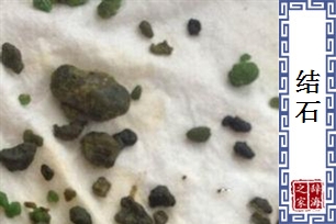 结石