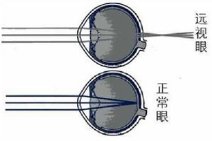 远视眼