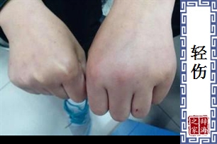 轻伤